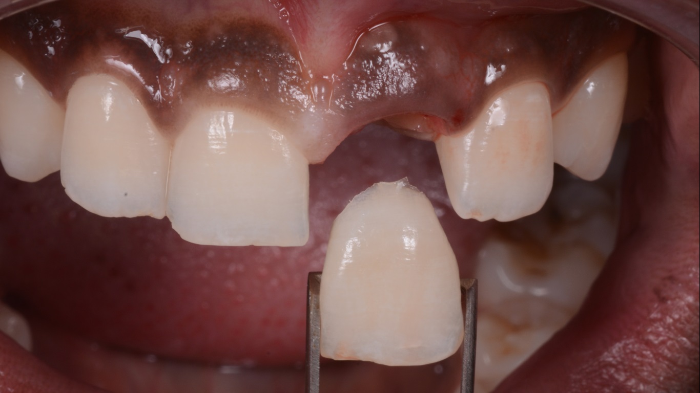 Restaurando o sorriso e a esperança de um jovem